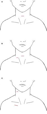 A scoping review of endoscopic and robotic techniques for lateral neck dissection in thyroid cancer
